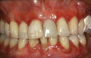 Gingivitis