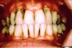 Severe Periodontitis Severe Periodontitis
